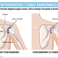 Porównanie zdrowego stawu ramiennego z tym dotkniętym chorobą zwyrodnieniową stawów, gdzie widać zniszczoną chrząstkę.