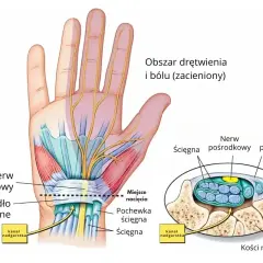 Anatomia dłoni i nadgarstka, pokazująca nerw pośrodkowy i ścięgna w kanale nadgarstka. Obszar drętwienia i bólu.