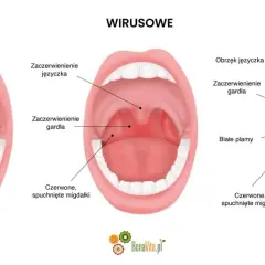 Porównanie gardła: normalne, z zaczerwienieniem języczka i gardła (angina wirusowa), oraz z białymi plamami i obrzękiem (angina bakteryjna).