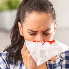 Kobieta z zaciśniętymi oczami przykłada do nosa chusteczkę z plamami krwi. Krwawienie z nosa jest nieprzyjemne.