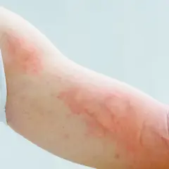 Ramię z widocznymi, swędzącymi czerwonymi plamami na ciele, prawdopodobnie objawem alergii lub pokrzywki.