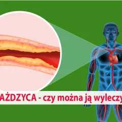 Zbliżenie na zatkaną miażdżycą tętnicę obok sylwetki człowieka z widocznym układem krwionośnym.