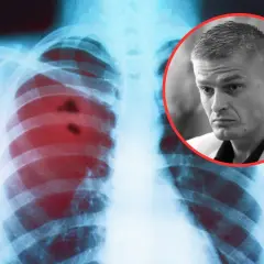 Rentgen klatki piersiowej z zaznaczonymi zmianami, sugerującymi raka płuc. Objawy mogą być subtelne.