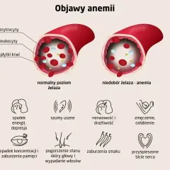 Ilustracja pokazuje naczynie krwionośne z normalnym poziomem żelaza i naczynie z niedoborem żelaza, co prowadzi do anemii. Objawy anemii to m.in. bladość skóry, spadek energii, bóle głowy.