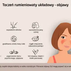 Pierwsze objawy tocznia: ból głowy, obrzęki, wypadanie włosów, owrzodzenia jamy ustnej, gorączka, utrata wagi, zmęczenie, wysypka motylkowa, problemy psychiczne, bóle stawów.