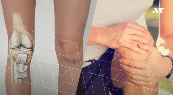 Anatomia kolana po lewej, po prawej osoba trzymająca się za bolące kolano.