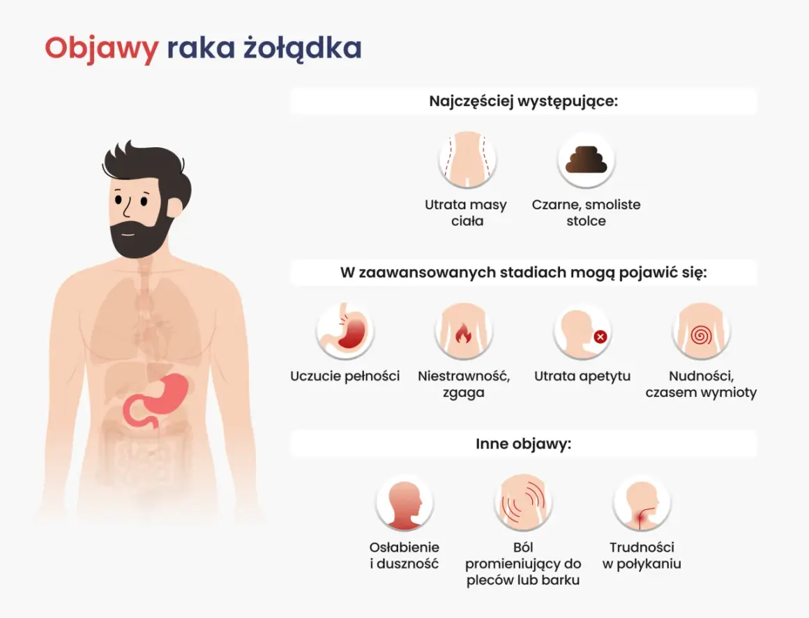 Ilustracja przedstawia objawy raka żołądka: utratę masy ciała, czarne stolce, uczucie pełności, niestrawność, zgagę, utratę apetytu, nudności, wymioty, osłabienie, ból pleców i trudności w połykaniu.