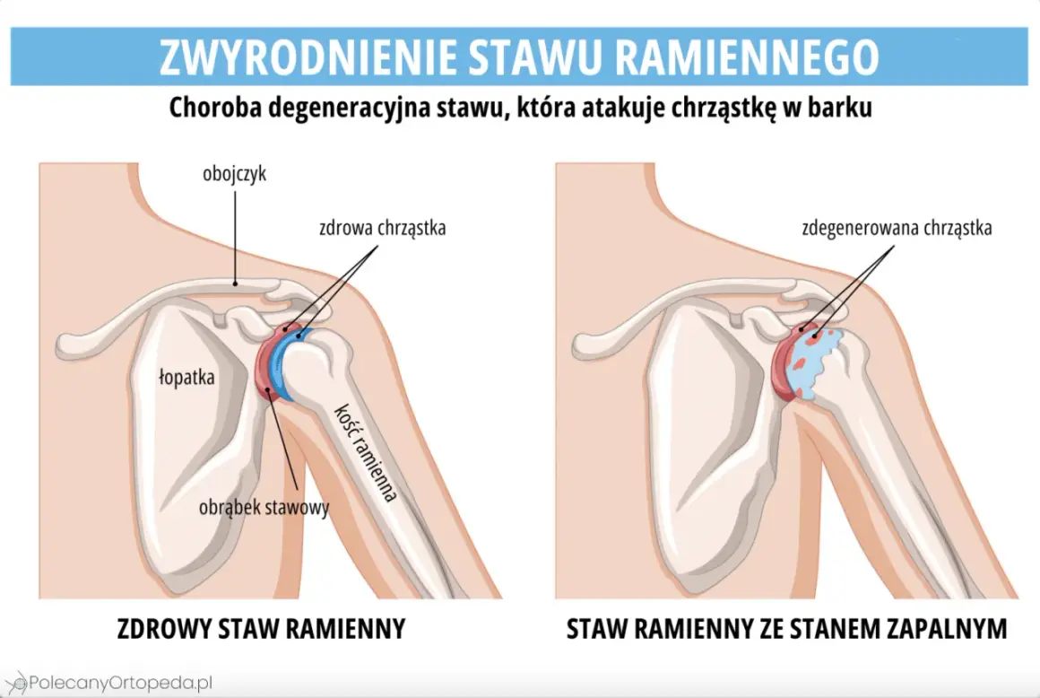 Porównanie zdrowego stawu ramiennego z tym dotkniętym chorobą zwyrodnieniową stawów, gdzie widać zniszczoną chrząstkę.