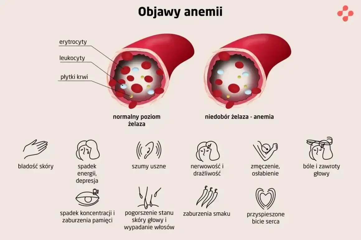 Ilustracja pokazuje naczynie krwionośne z normalnym poziomem żelaza i naczynie z niedoborem żelaza, co prowadzi do anemii. Objawy anemii to m.in. bladość skóry, spadek energii, bóle głowy.