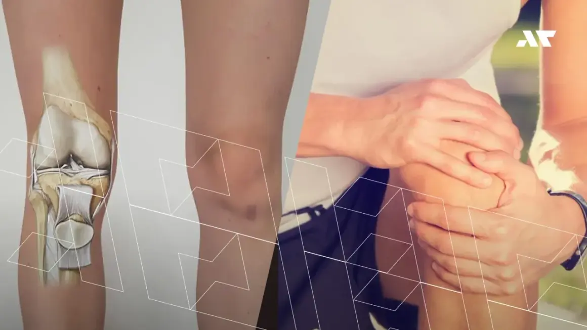 Anatomia kolana po lewej, po prawej osoba trzymająca się za bolące kolano.