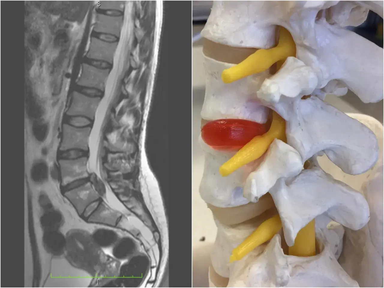 MRI kręgosłupa lędźwiowego i model anatomiczny ukazujący dyskopatię, gdzie wypuklina krążka międzykręgowego uciska nerw.