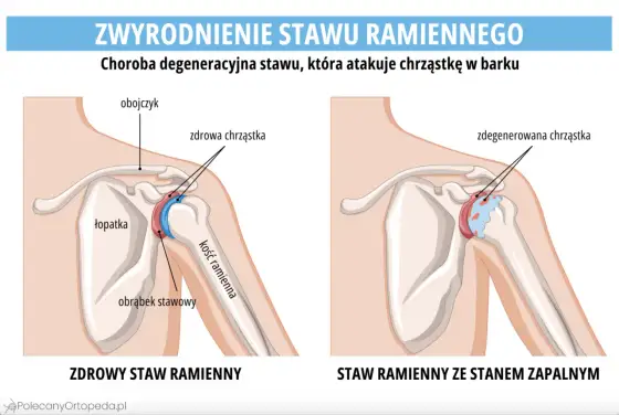 Choroba zwyrodnieniowa stawów - objawy i bezpieczny ruch