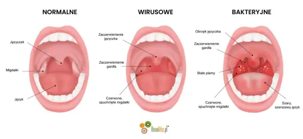 Porównanie gardła: normalne, z zaczerwienieniem języczka i gardła (angina wirusowa), oraz z białymi plamami i obrzękiem (angina bakteryjna).