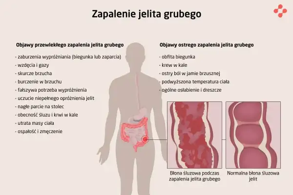Ilustracja przedstawia objawy zapalenia jelita grubego, w tym wrzodziejące zmiany błony śluzowej.