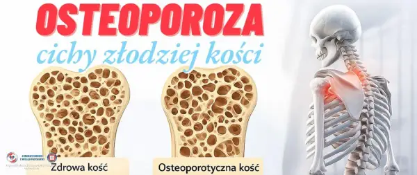 Osteoporoza: porównanie zdrowej i osteoporotycznej kości. Szkielet z zaznaczonym bólem w obrębie barku.