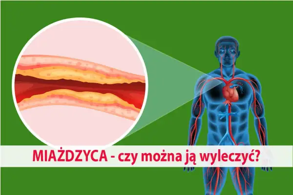 Zbliżenie na zatkaną miażdżycą tętnicę obok sylwetki człowieka z widocznym układem krwionośnym.