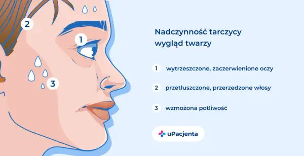 Nadczynność tarczycy objawy: wytrzeszczone oczy, przetłuszczone włosy i wzmożona potliwość.